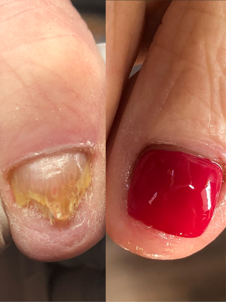 Toenail Reconstruction