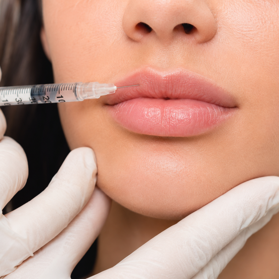 Partial Lip Filler at TrueBalance Medical Aesthetics & Wellness in Lake Ozark, MO