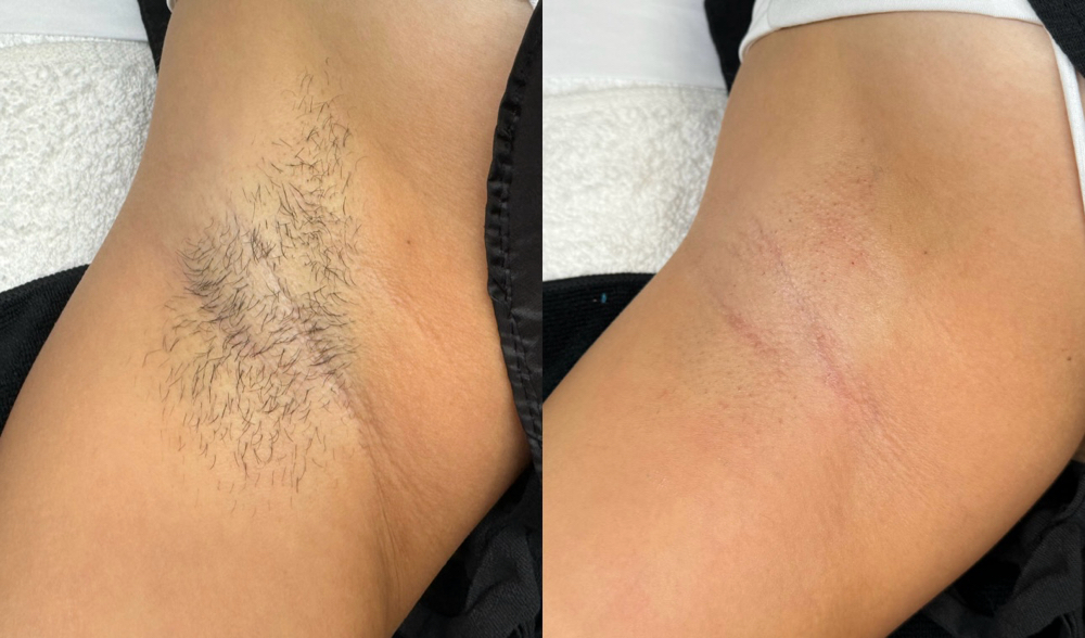 Underarm Wax