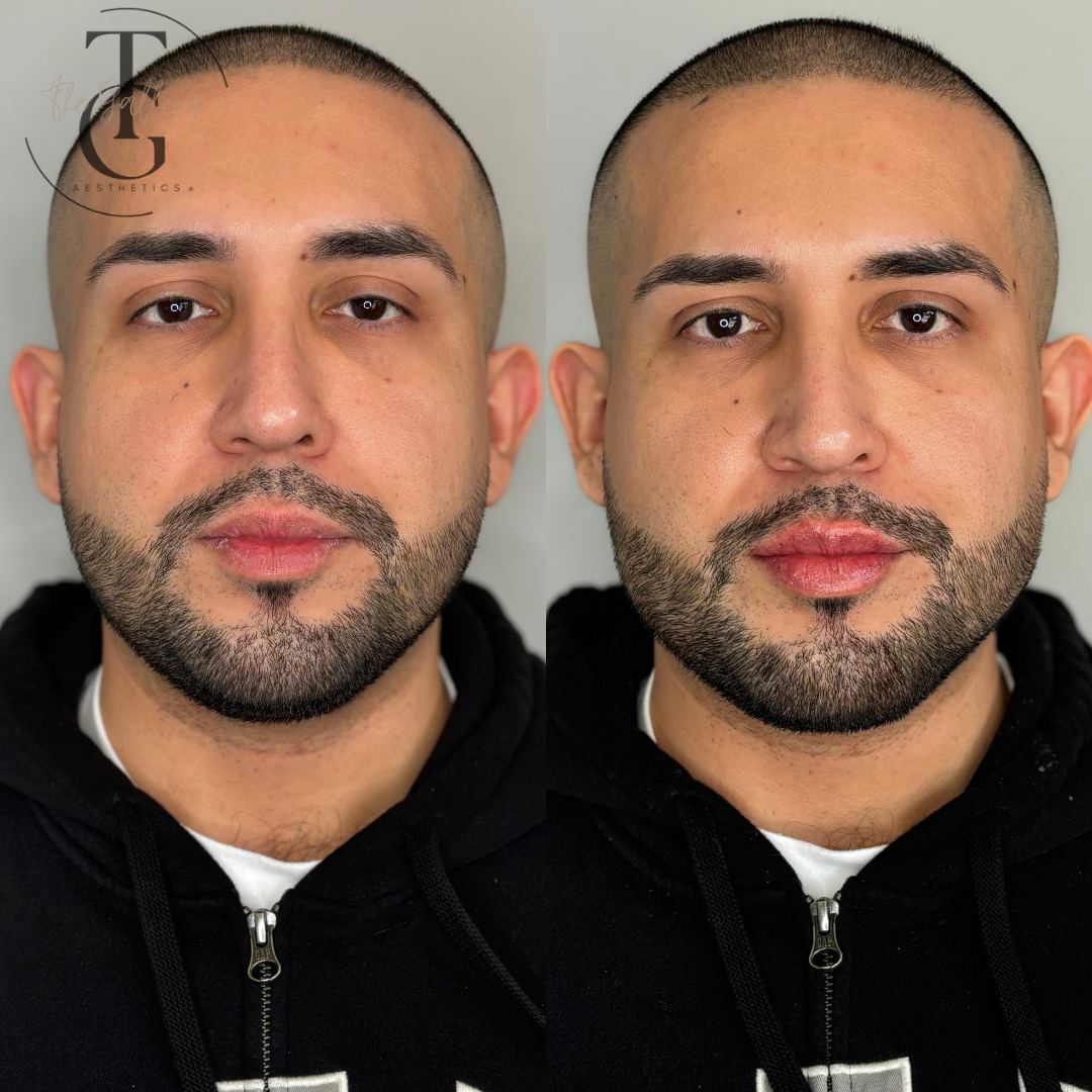 Chin Filler