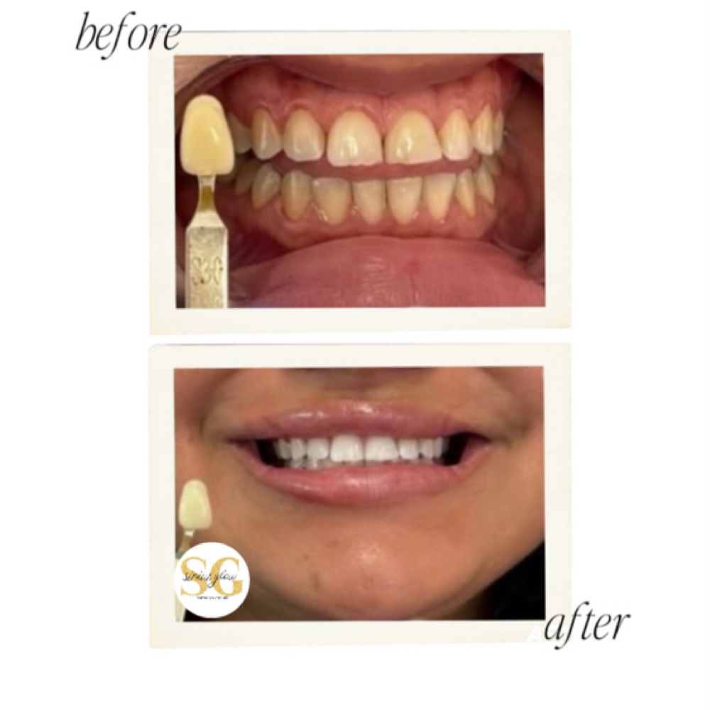 Heavy Treatment▫️one client at Sirius Glow Teeth Whitening in Pasadena, TX
