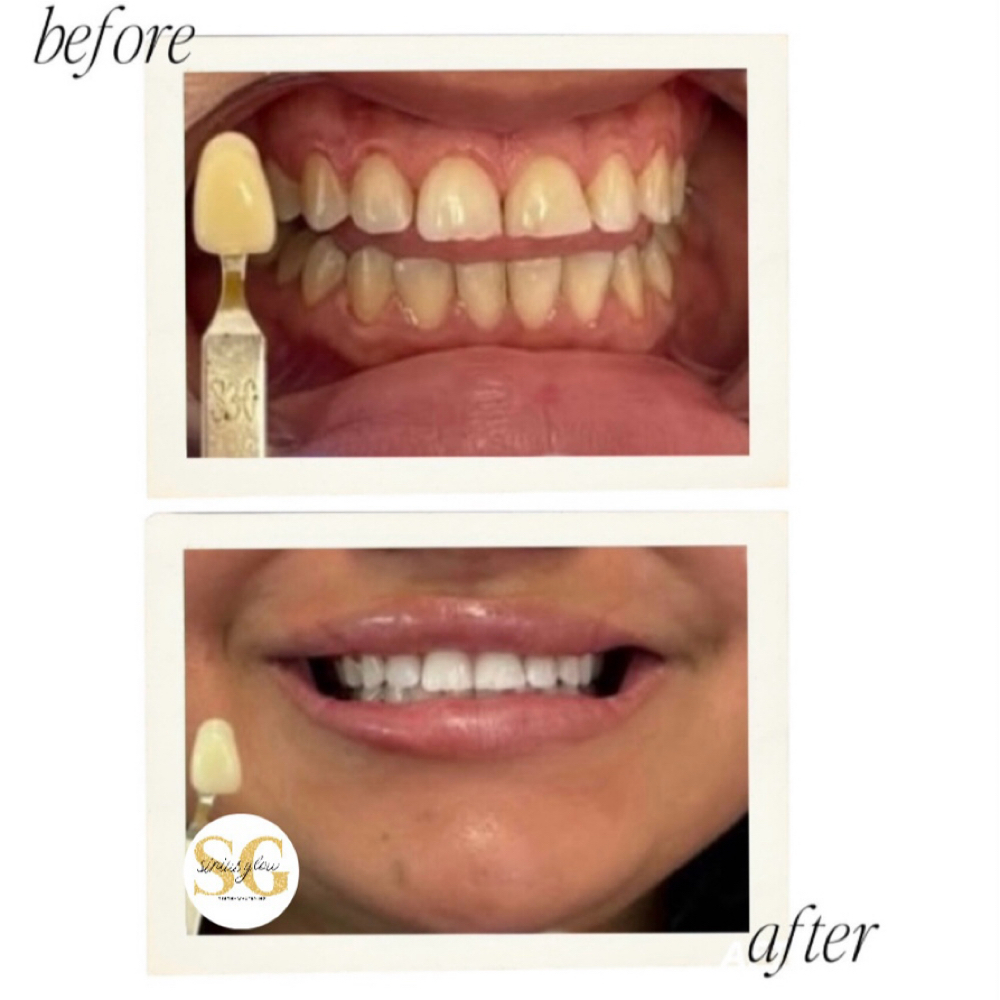 Heavy Treatment▫️one client at Sirius Glow Teeth Whitening in Pasadena, TX