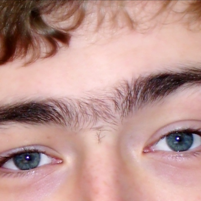 Laser Hair Removal / Glabella at Finalé Hair Removal And Skin Care in Minnetonka, MN