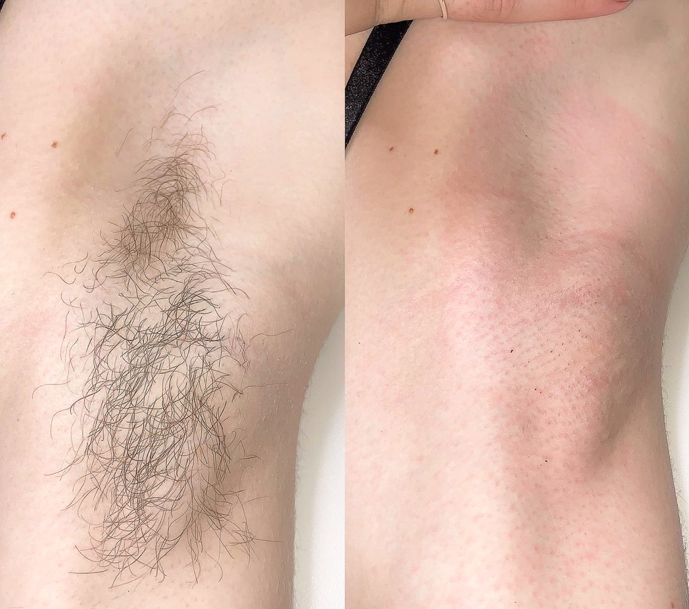 Underarm Wax