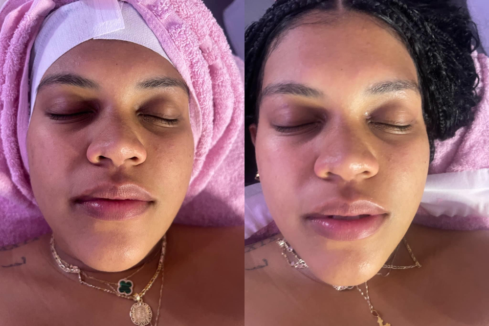 Dermplaning Facial