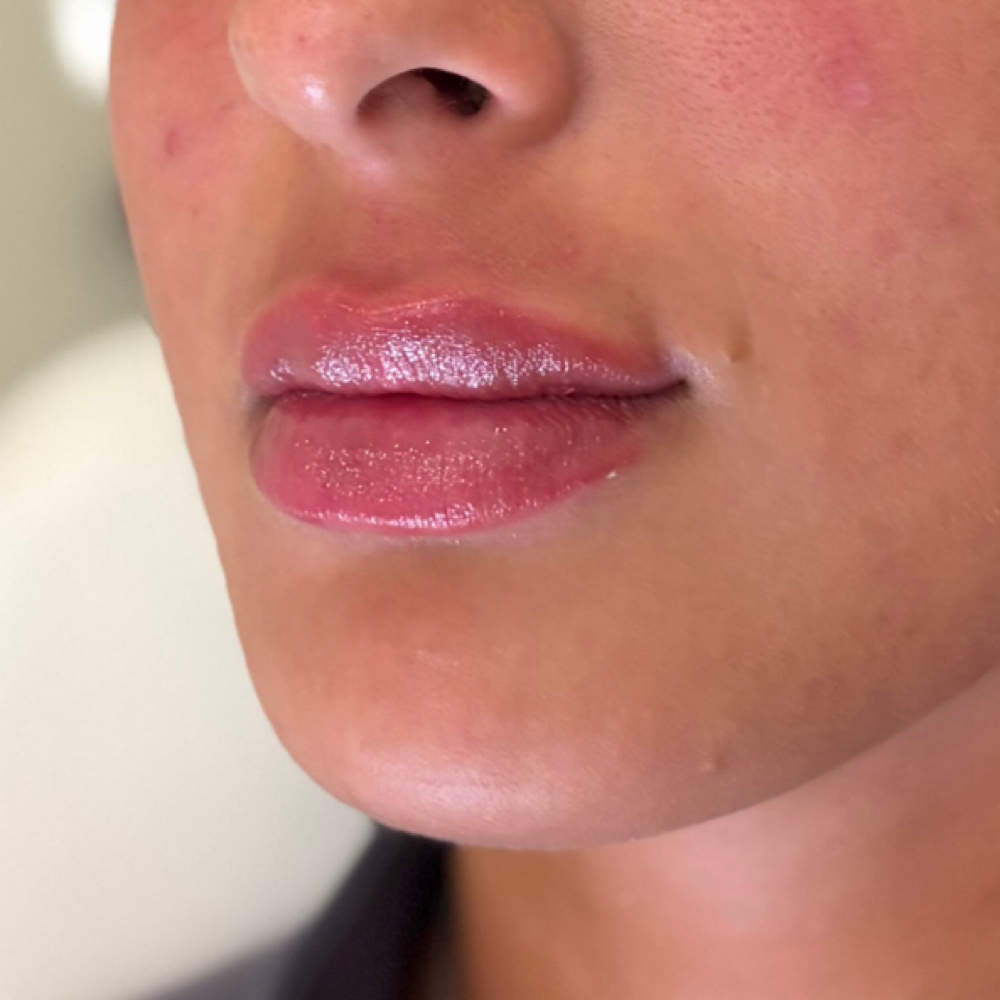 Lip Enhancement at Beauty Lab in Montclair, NJ