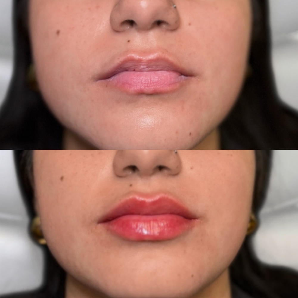 Lip Enhancement at Beauty Lab in Montclair, NJ