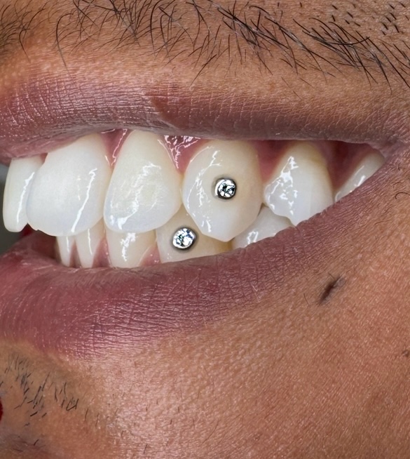 VVS Diamond Tooth Gems