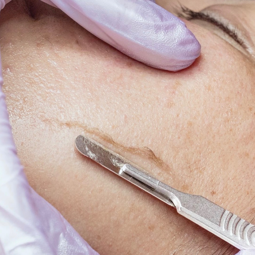 Dermaplaning Facial at Golden Hour Esthetics in Tullahoma, TN