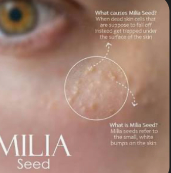 Milia Extract