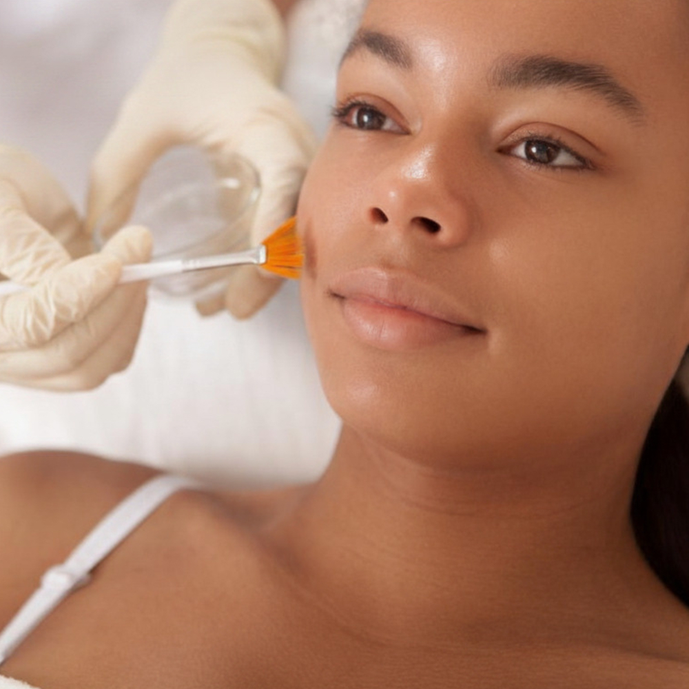 Facial Acne Treatment at Estética by Martha in Feasterville, PA