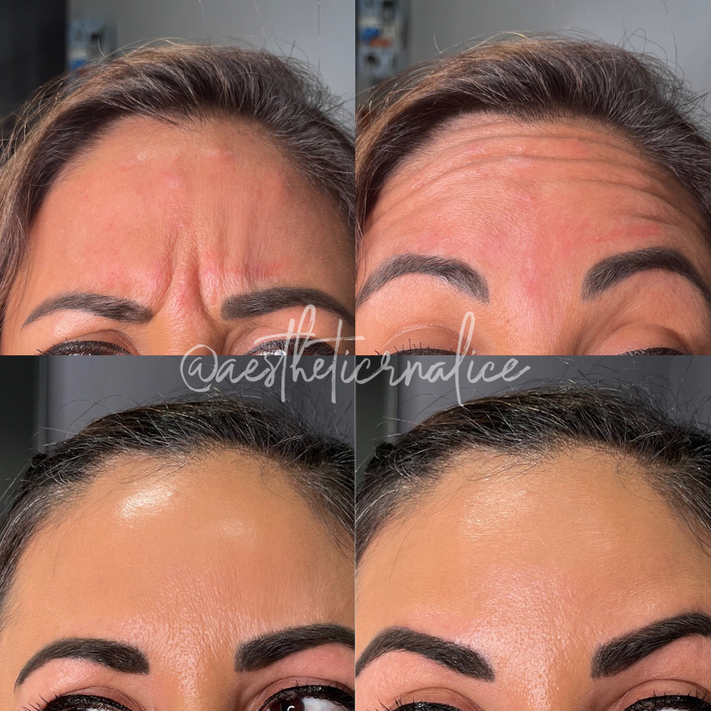 Wrinkle relaxers