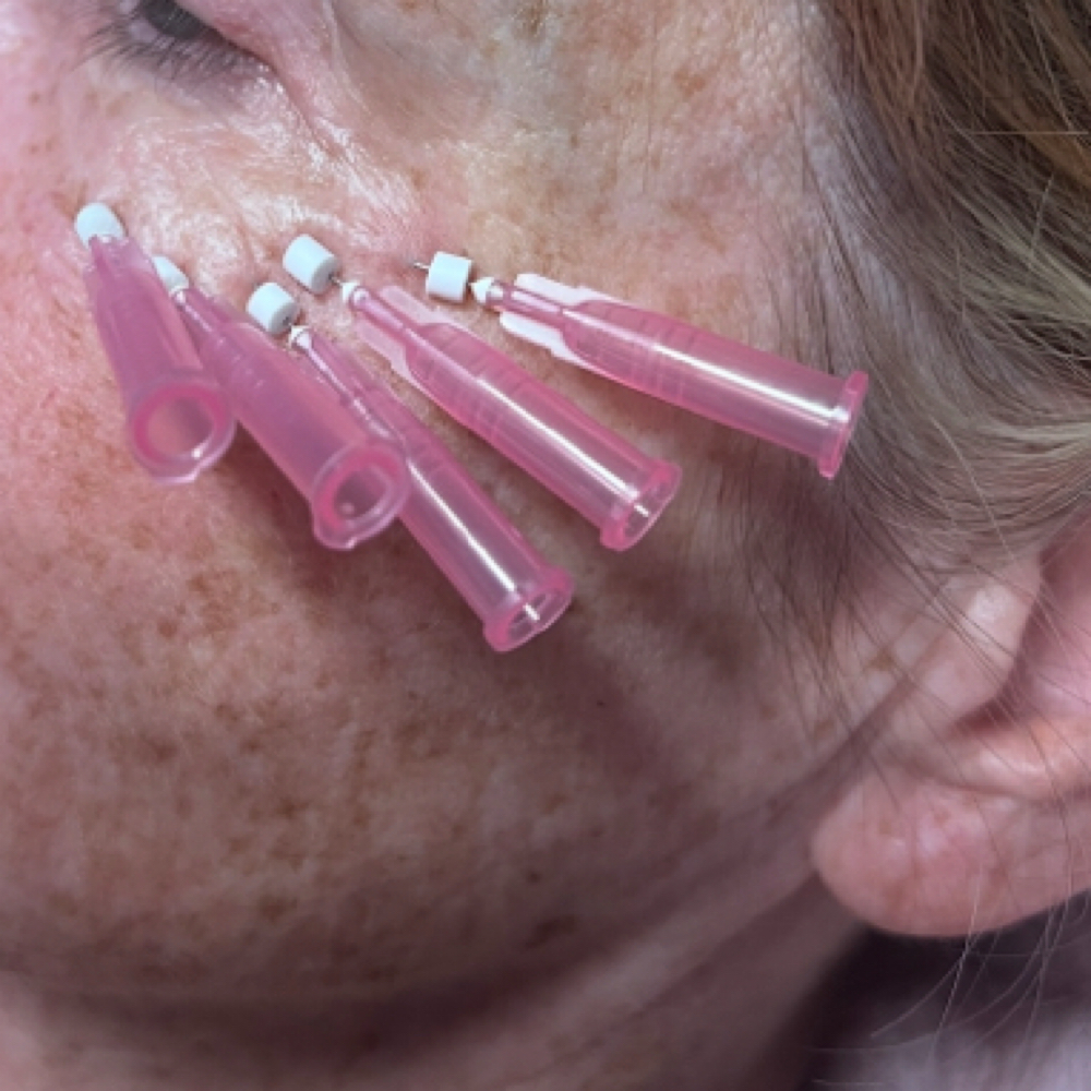PDO Threads at Southern Sparkle Medical Aesthetics in Swainsboro, GA