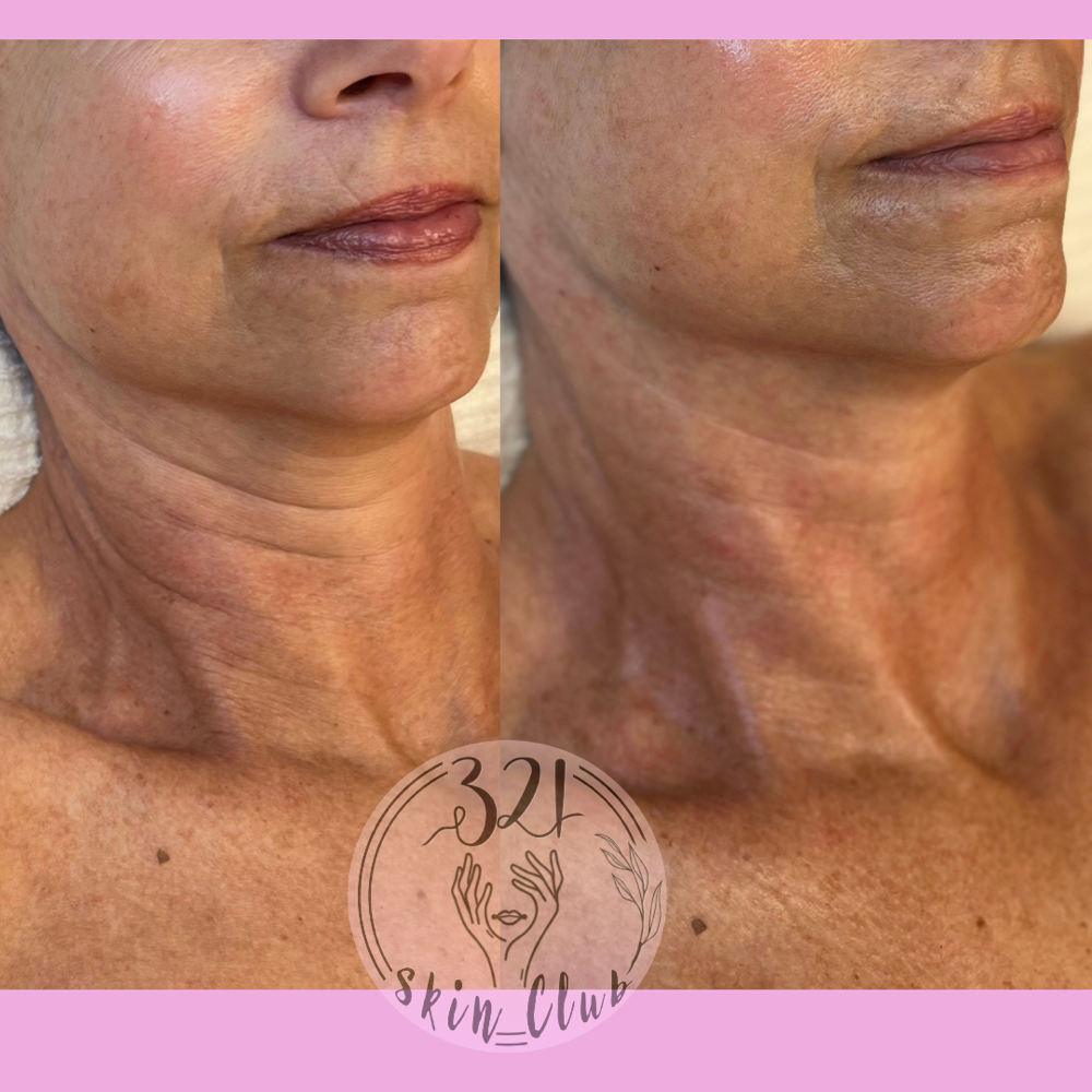 Anti-aging facial