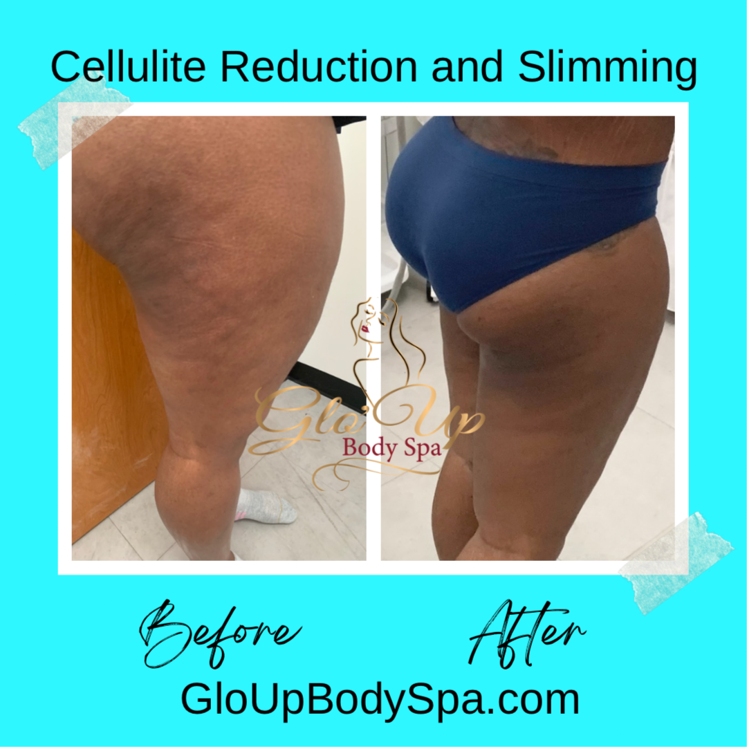 4 Cellulite Reduction treatments at Glo'Up Body Spa in Atlanta, GA