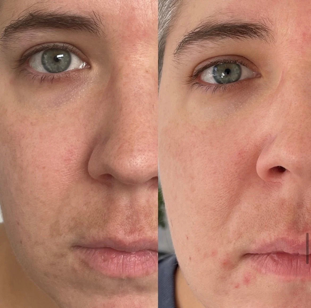 The Lazer Peel at Seraphina Skin . Energy . Ritual in Bay Shore, NY