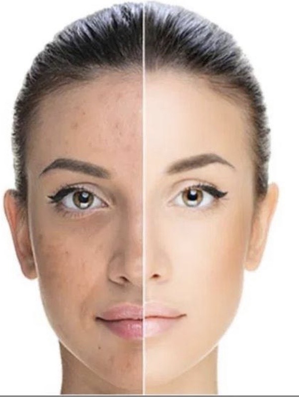 Fire & Ice Chemical Peel Treatment