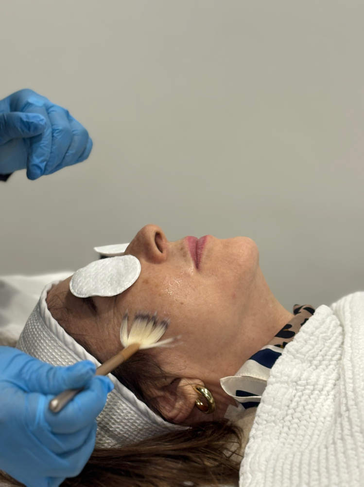 Chemical Peel Facial