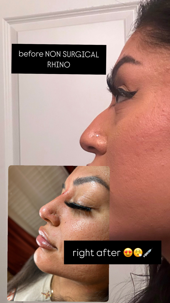Non Surgical Rhino