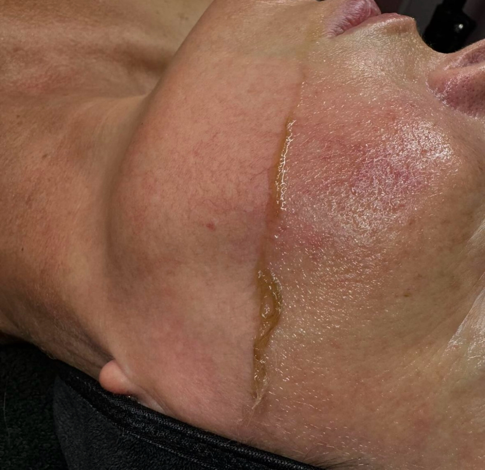 Dermaplaning Facial
