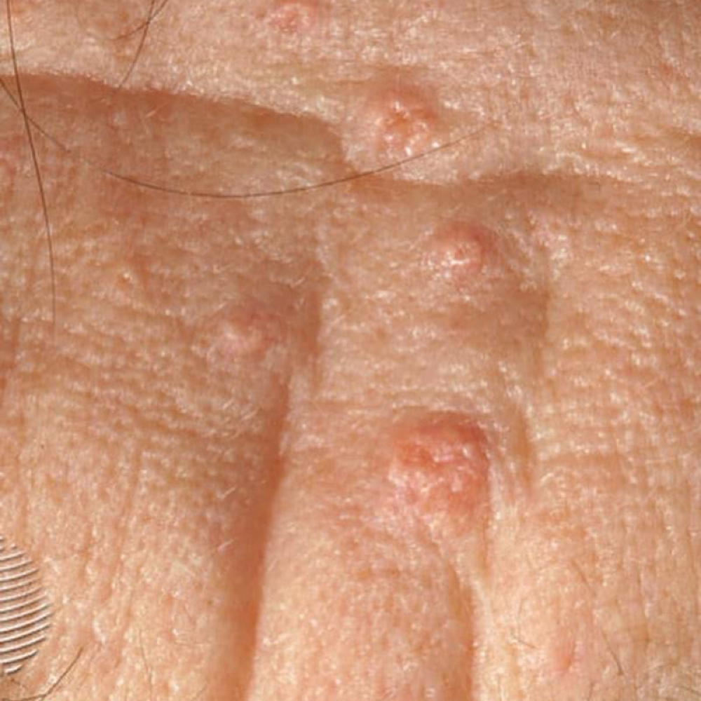 Skin Tags, Seborrheic Keratosis Tx at Holistic Skin Center in Edgewater, FL