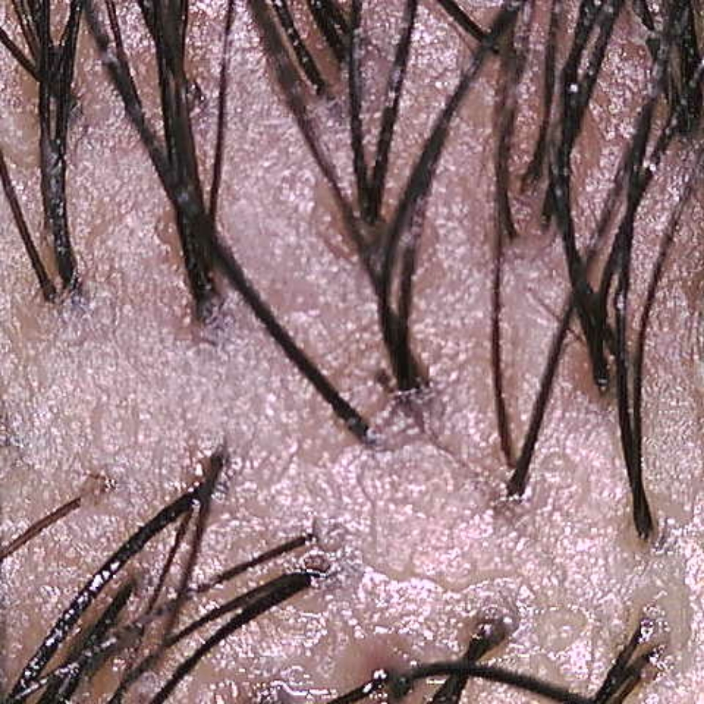 Trichoscopy(Scalp Image/Treatplan at Traveling Stylist Caprisha Daniels in San Luis Obispo, CA