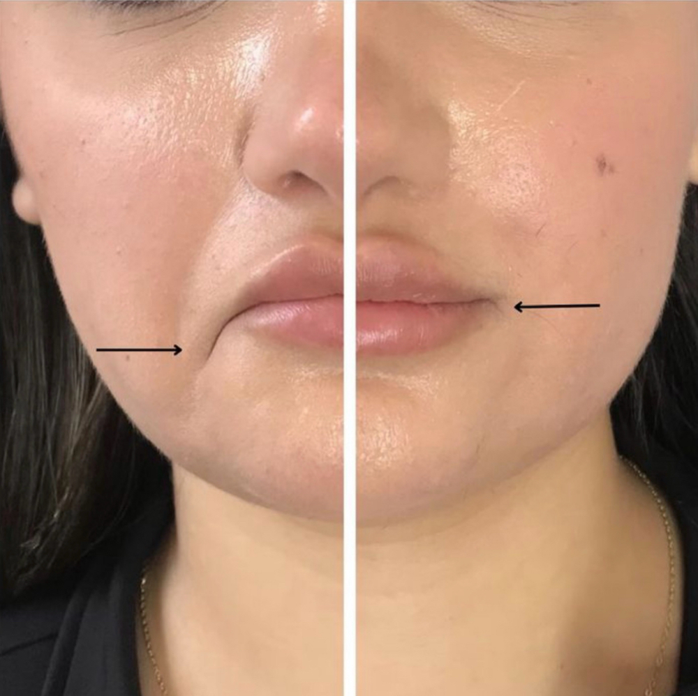 D.A.O-The Instant Uplift Treatment at Bliss Beauty Bar in Houston, TX