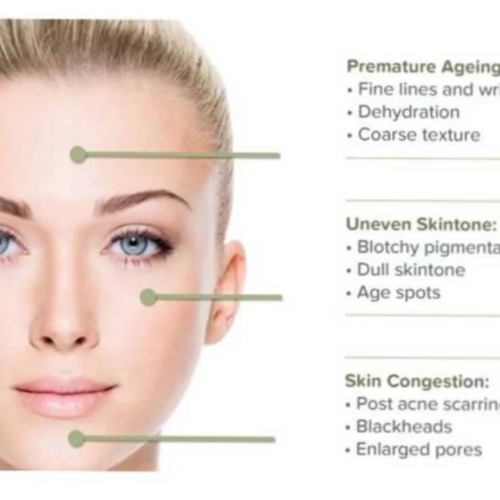 Bella MicroDermabrasion Facial at Allie-Bella HeadSpa & Facials in Boca Raton, FL