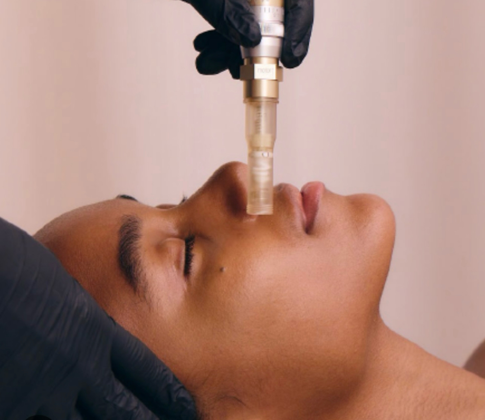 Belle Nano-Needling- Add On