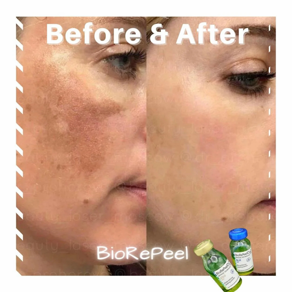 BioRePeel Chemical Peel at Monroe’s Everlasting Beauty in Corpus Christi, TX