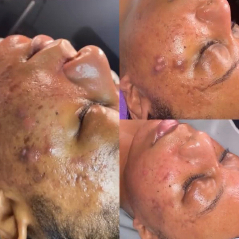 Microneedling Facial at Tye Hughes in Charlotte, NC