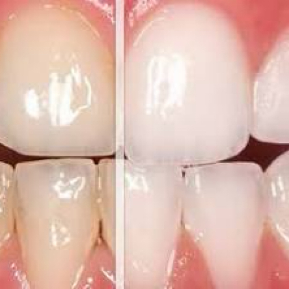 Teeth Whitening at Bottumzup Health and Wellness,LLC in Davenport, FL