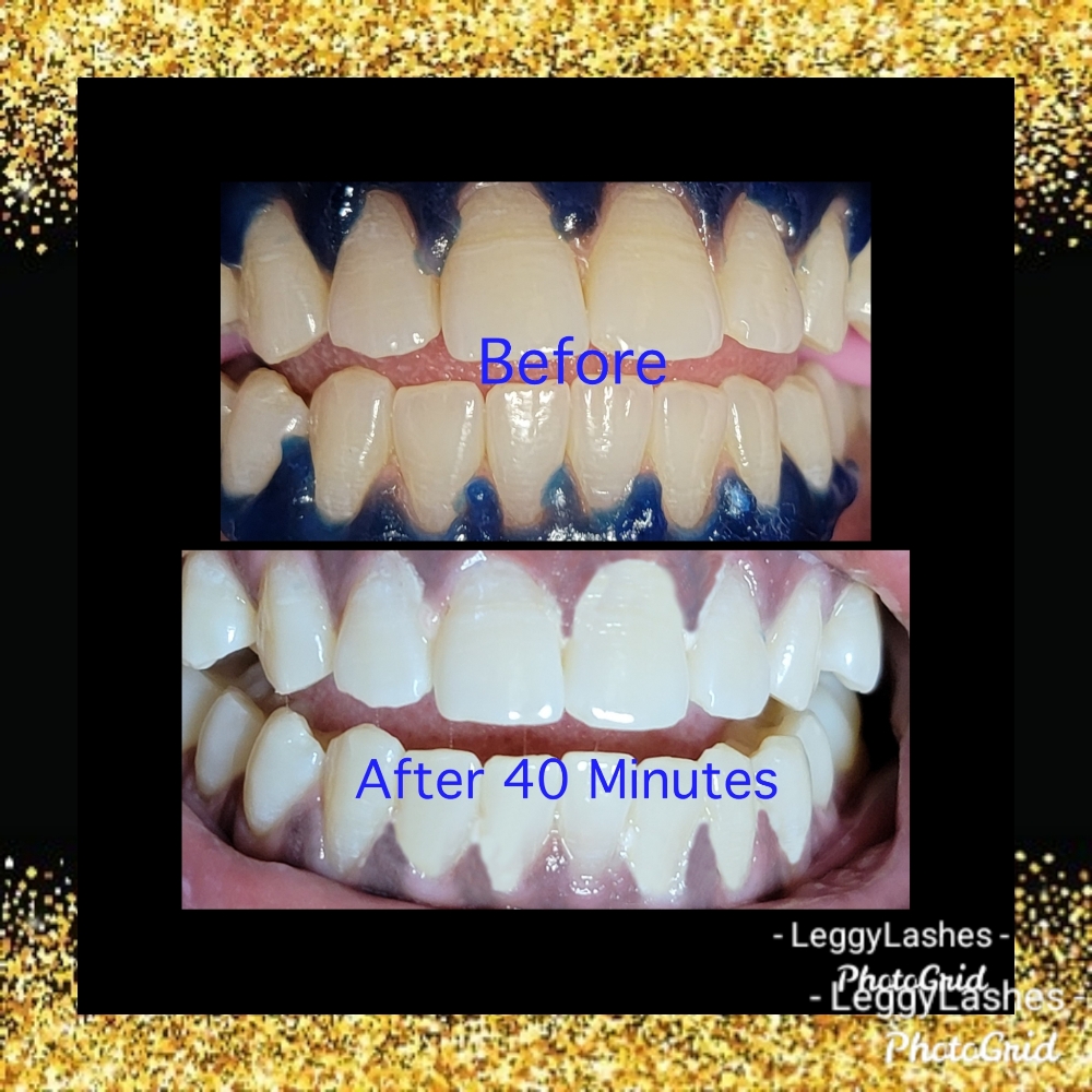 40 Minute Zoom Teeth Whitening