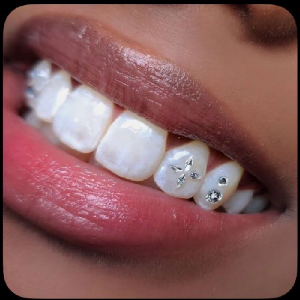 4-6 Tooth Gem at Ice Queen Whitening in Hillsboro, OR