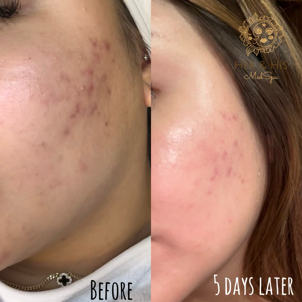 BioMicroneedling Resurfacing