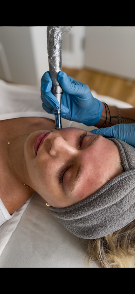 Second Microneedling Treatment
