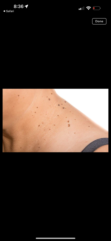 Skin Tags