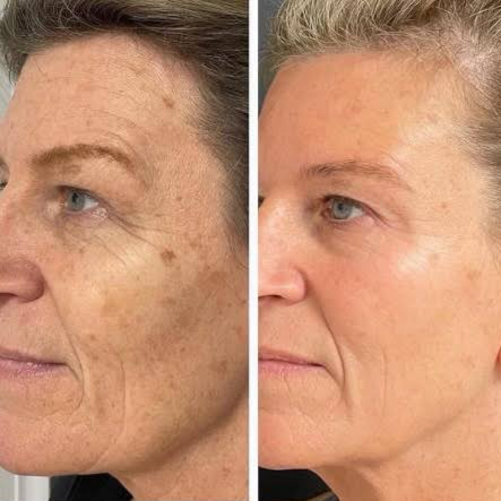 PROCELL microchanneling at Glamour Beauty House in Fort Myers, FL