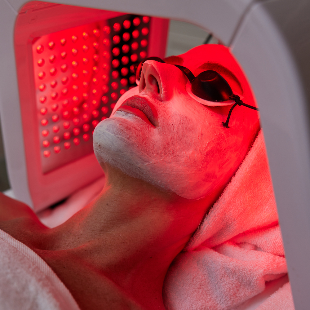 Inflamatory Acne Peel at Estética by Martha in Feasterville, PA