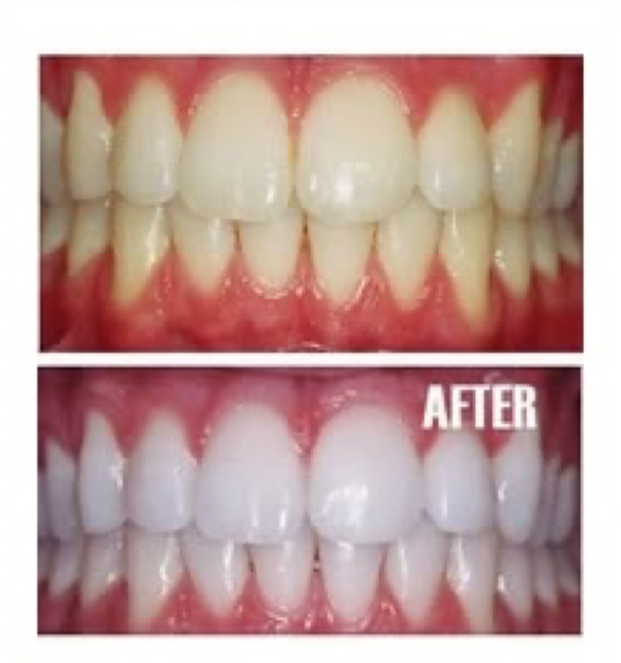 Teeth Whitening at THE BEAUTY SLANGER in Hacienda Heights, CA