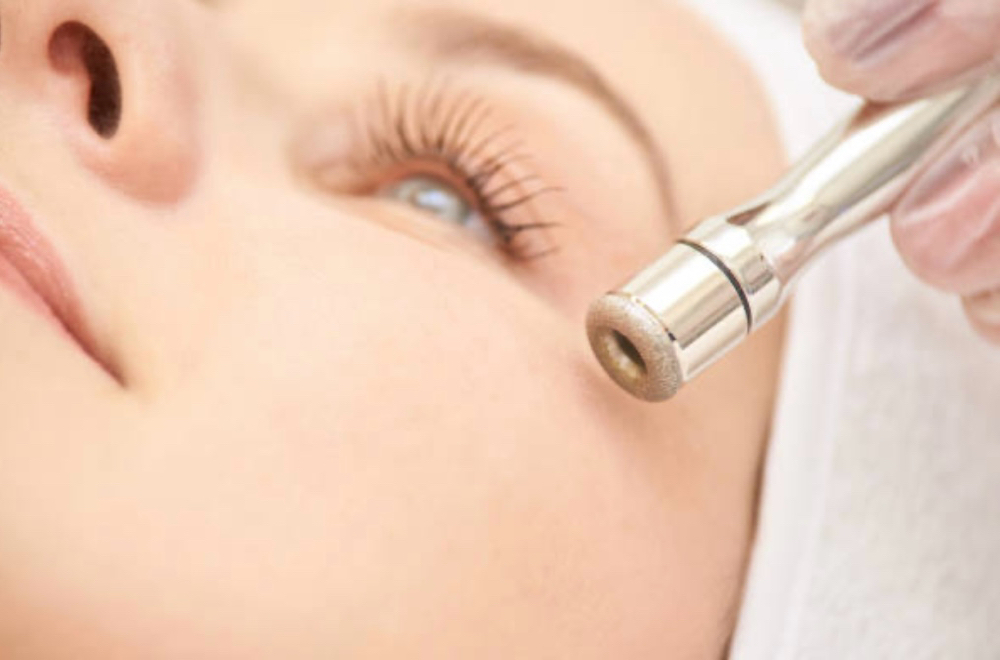 Microdermabrasion