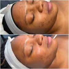Pigment Correct Peel