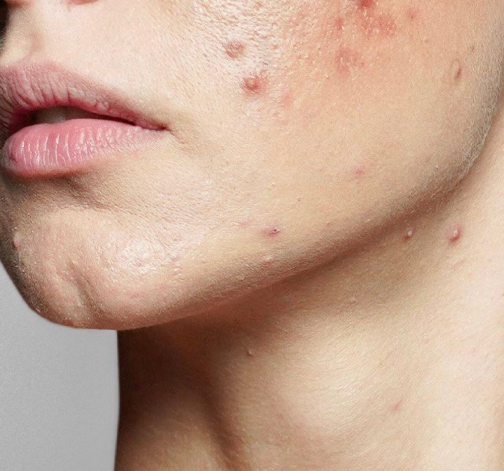 ACNE FACIAL