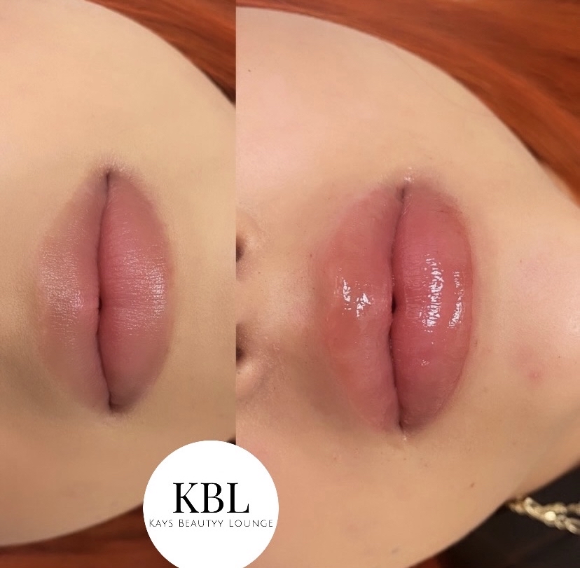 2ml Needless Lip Filler Jan Promo