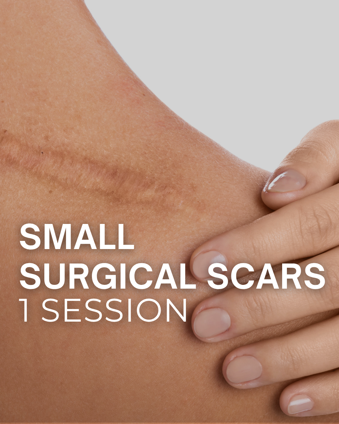 Small Surgical Scars - 1 Session at TRUE HUE AESTHETICS in Beverly Hills, CA