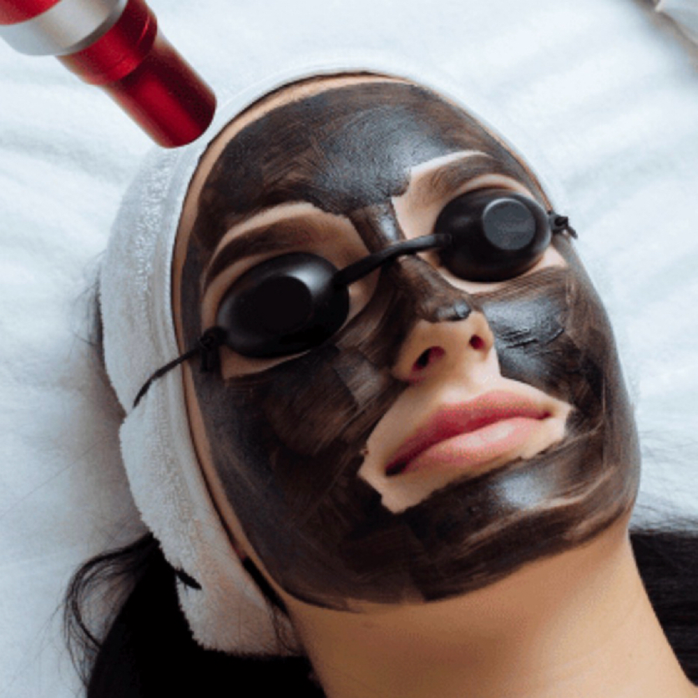 Carbon Laser Facial at Southern Sparkle Medical Aesthetics in Swainsboro, GA