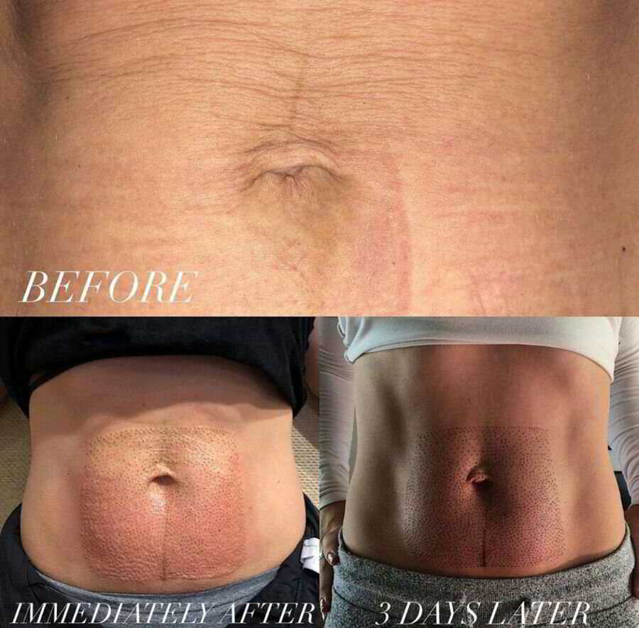 Belly Lift Plasma Fibroblast