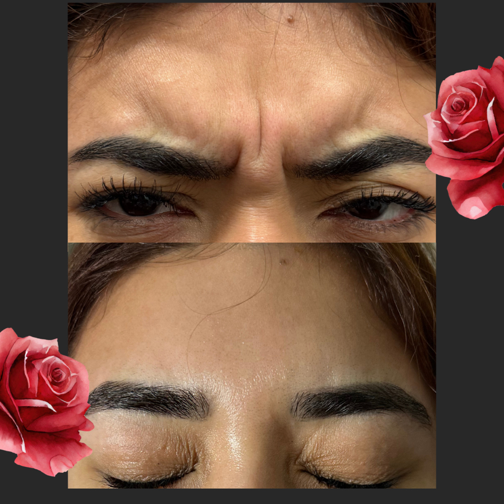 Botox Injections at Forever Young Beauty RN in Rowlett, TX