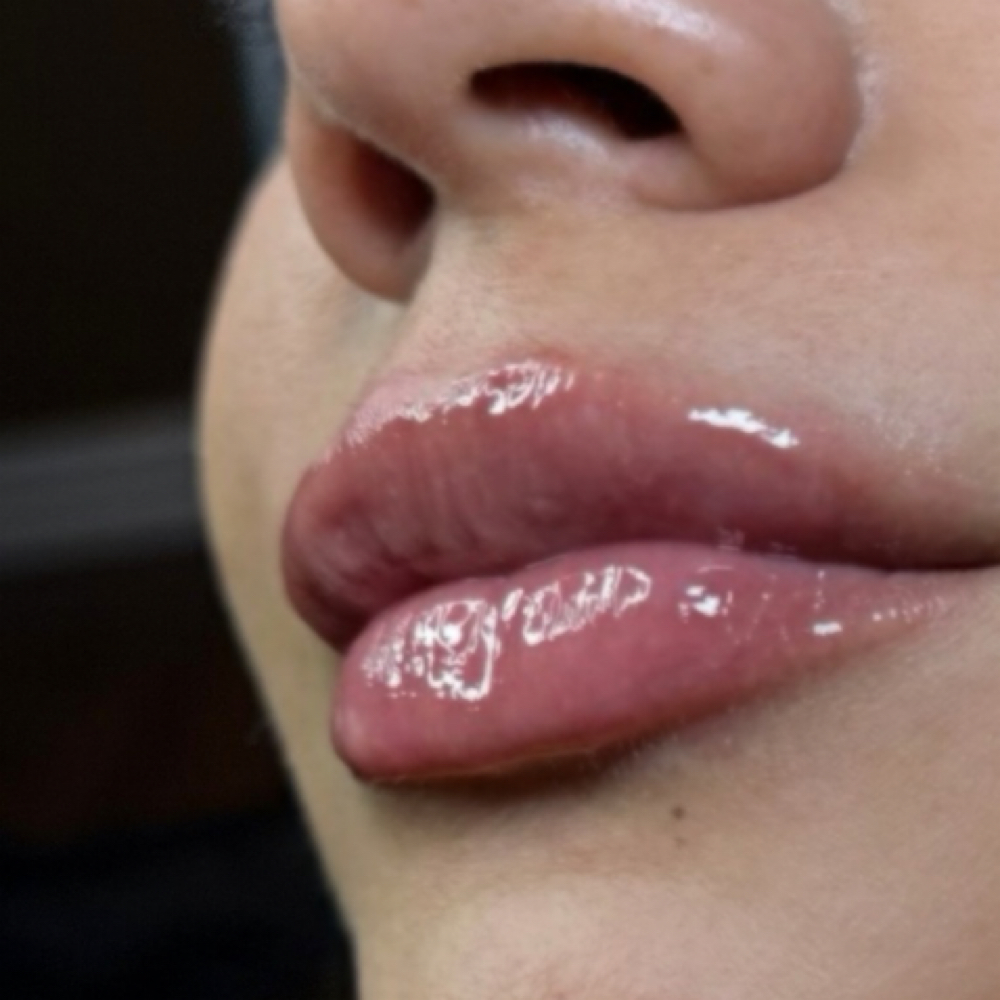 LIP FILLER 0.5ML at Lavish.withLo in Sunnyvale, TX