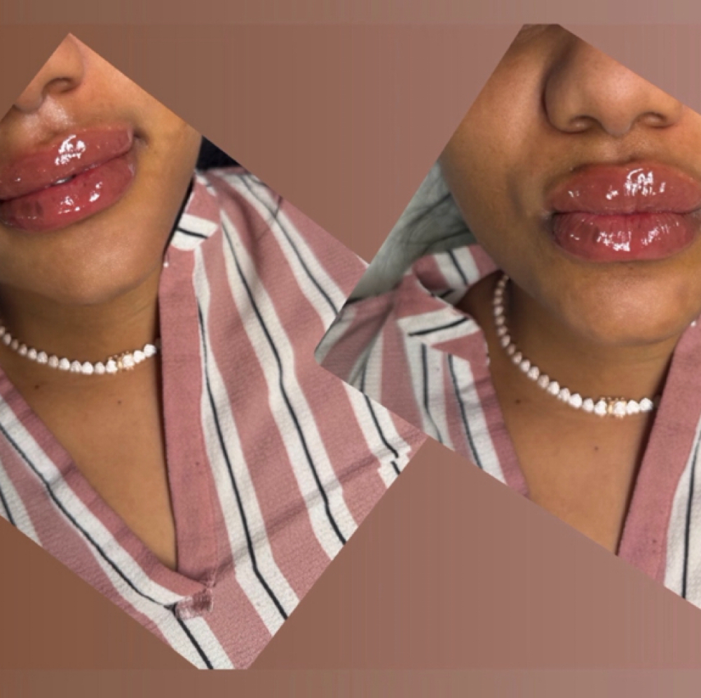 👄 Labios Rellenos at Tayselfcarestudio LLC in Lawrence, MA